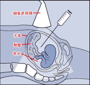 无创DNA检测靠谱吗?能检查出脑积水吗?