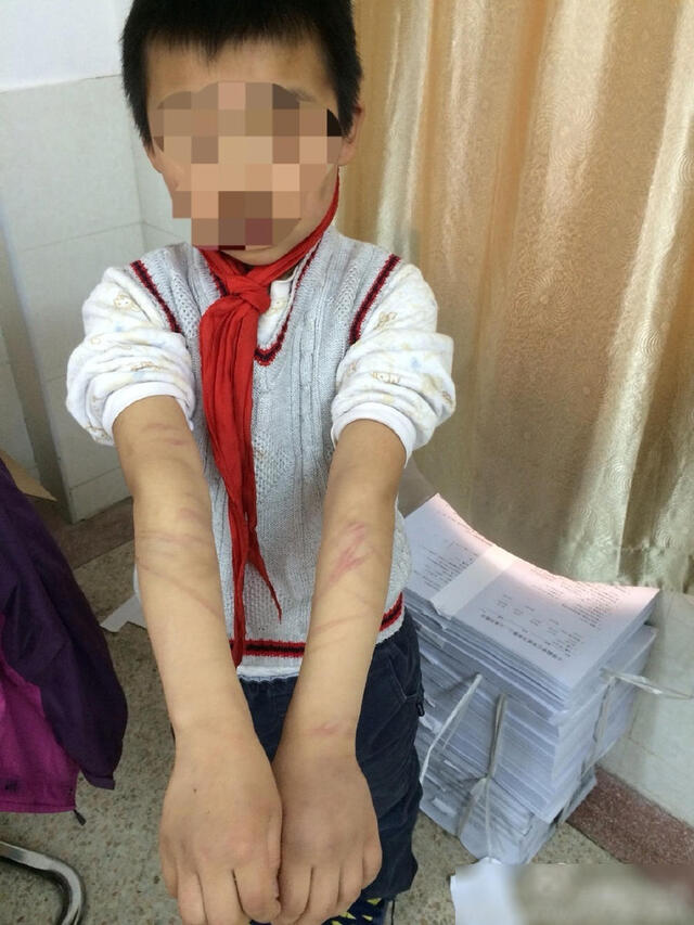 唐山被打女孩鉴定结果出来了，轻伤二级不严重？重伤得终身残疾